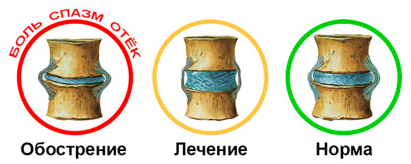 Боль в спине