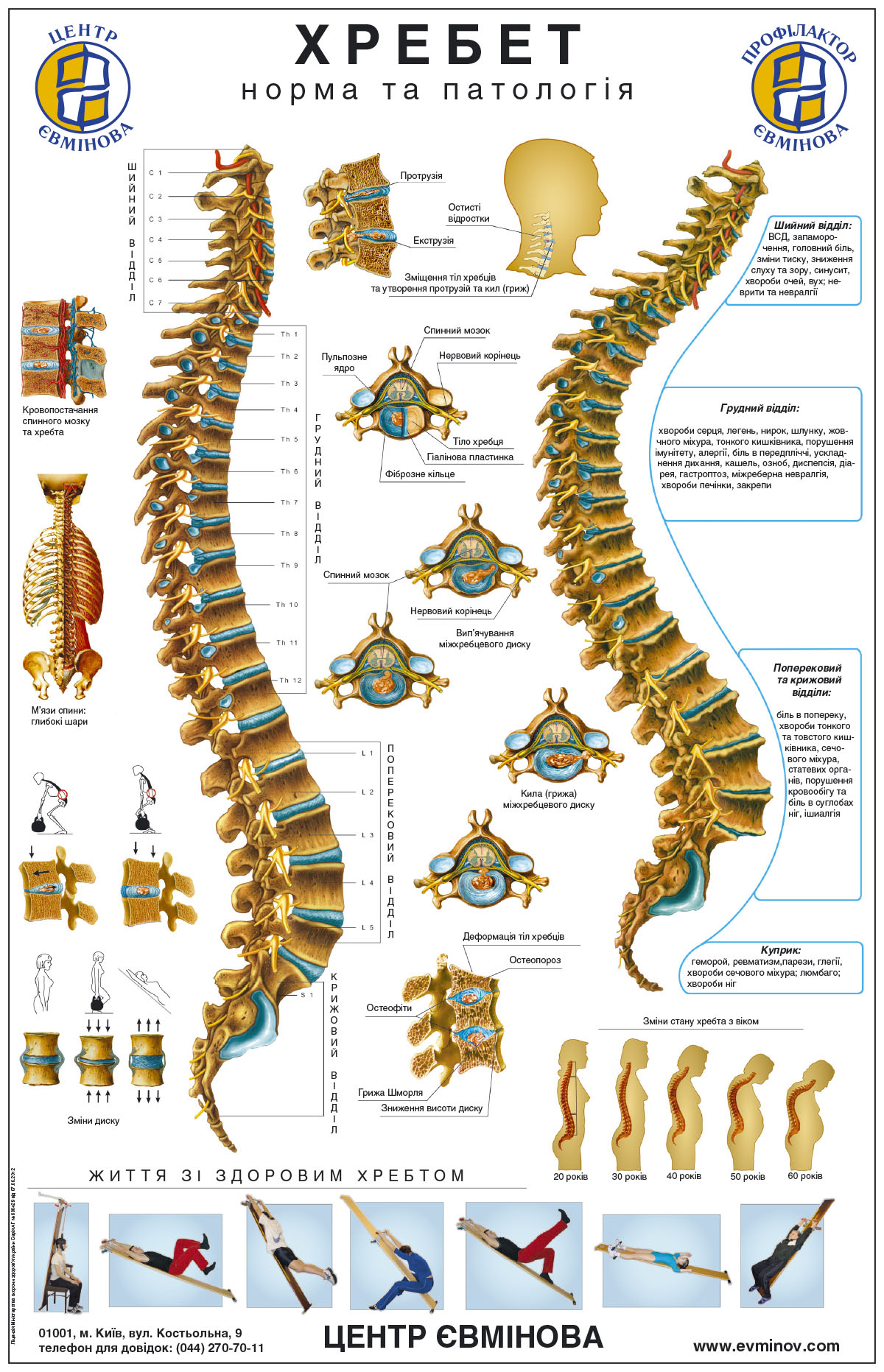 остеохондроз плакат